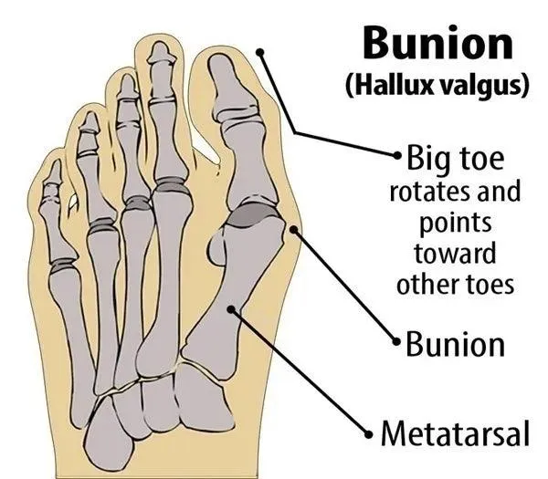 Bunion Relief Sleeve with Gel Pad: Ultimate Foot Comfort & Pain Relief