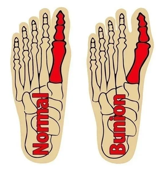 Bunion Relief Sleeve with Gel Pad: Ultimate Foot Comfort & Pain Relief